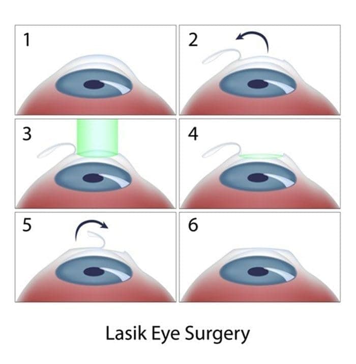 תרשים שלבי ניתוח LASIK